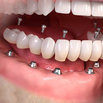 Dental Implants